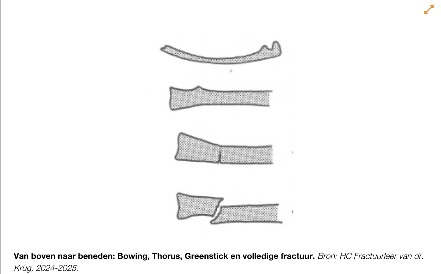 <p>Onvolledige breuk (één zijde cortex breekt)</p>