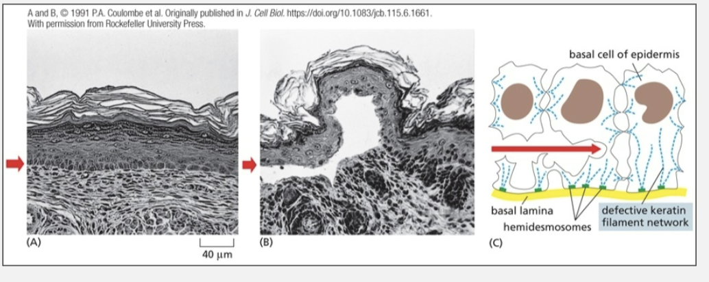 <ul><li><p>results in a blistering phenotype when co-expressed in cells expressing wild type keratin</p></li></ul><p></p>
