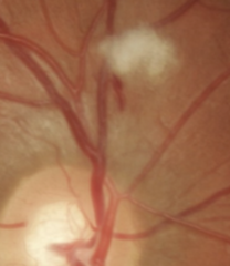 <p>Why do cotton wool spots occur with hypertensive retinopathy?</p>