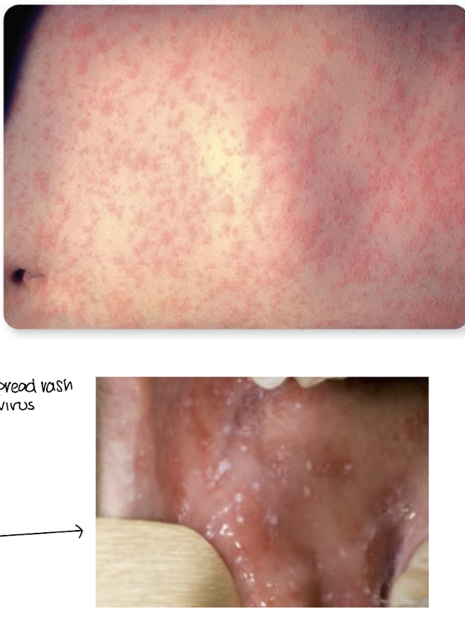 <ul><li><p>sore throat</p></li><li><p>dry cough</p></li><li><p>headache</p></li><li><p>conjunctivitis</p></li><li><p>lymphadenitis</p></li><li><p>fever</p></li><li><p>red, macropapular exanthem that begins on head and spreads to trunk and extremities</p></li><li><p>Kopliks spots</p></li></ul><p></p>