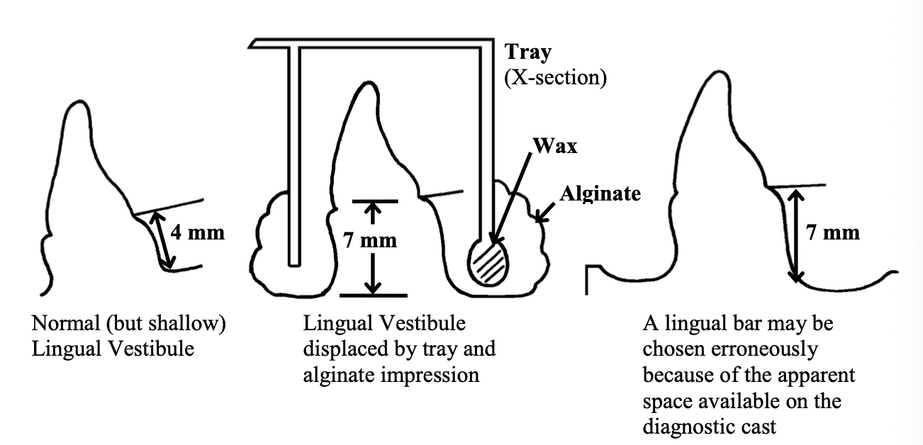 <p>Normal vestibule is 4mm, but alginate captures displaced tissue at 7mm. Now u chose a lingual bar because u thought u had space</p>