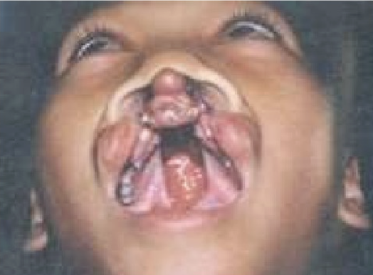 <p>Bilateral Cleft of lip and palate </p>