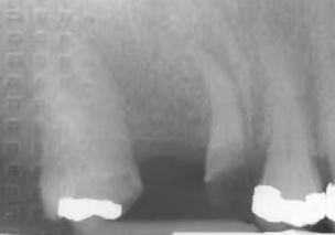 <p>Herringbone Pattern </p><p><strong>What it looks like:</strong><br>A <strong>tire-track or fishbone pattern</strong> across the image.</p><p> </p><p><strong>Cause:</strong><br>Film placed <strong>backwards</strong>.</p>