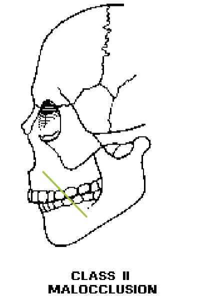 <p>Class II Malocclusion </p>