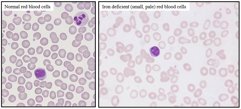 <p>- Anaemia (low Hb); reduced MCV (<80 fl)</p><p>- blood film: hypochromic (pale) microcytic (small) red blood cells, pencil-shaped cells and elliptocytes</p>