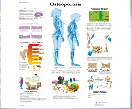 <p>Osteoporosis</p>