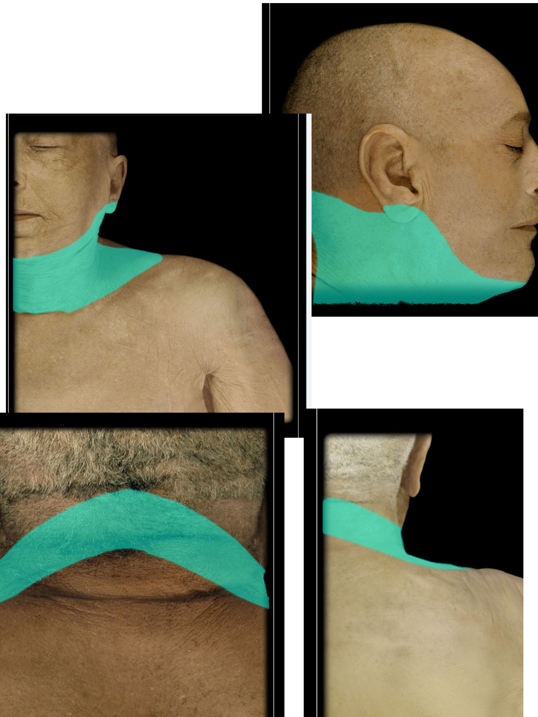 <p>C3 Dermatome</p>