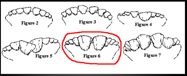 <p>Based on the eruption of the incisors</p><ul><li><p>Figure 6 shows full eruption and leveling </p></li><li><p>Figure 3 shows rough cut-off point (~30 months)</p></li></ul><p></p>