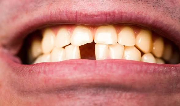 <p>Pérdida parcial o total de las piezas dentales. </p>
