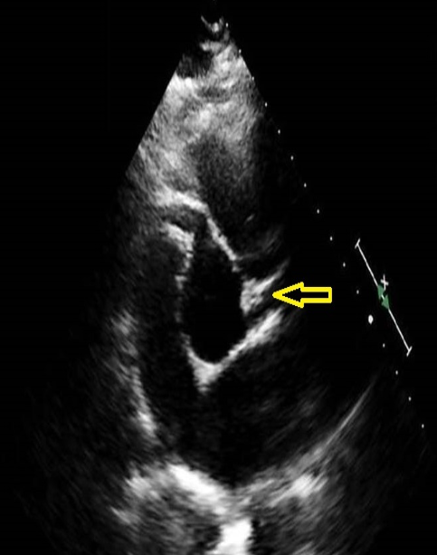 <p>color doppler is applied over the vessel indicated with the arrow. The map demonstrates flow away as blue. what color will fill the the vessel during diastole? </p>