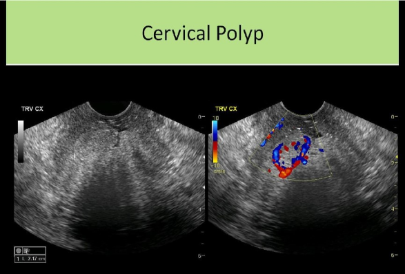 <p>C. the formation of cervical polyps</p><p>Chronic PID leads to hydrosalpinx, thin-walled, nodular fallopian tube, and peritoneal inclusion cyst formation. It has also been associated with cervical polyp formation.</p>