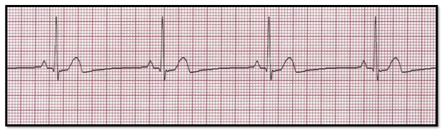 <p></p><p></p><p>Identify:<br>a. normal sinus rhythm<br>b. sinus bradycardia<br>c. 1st degree heart block<br>d. sinus arrhythmia </p>