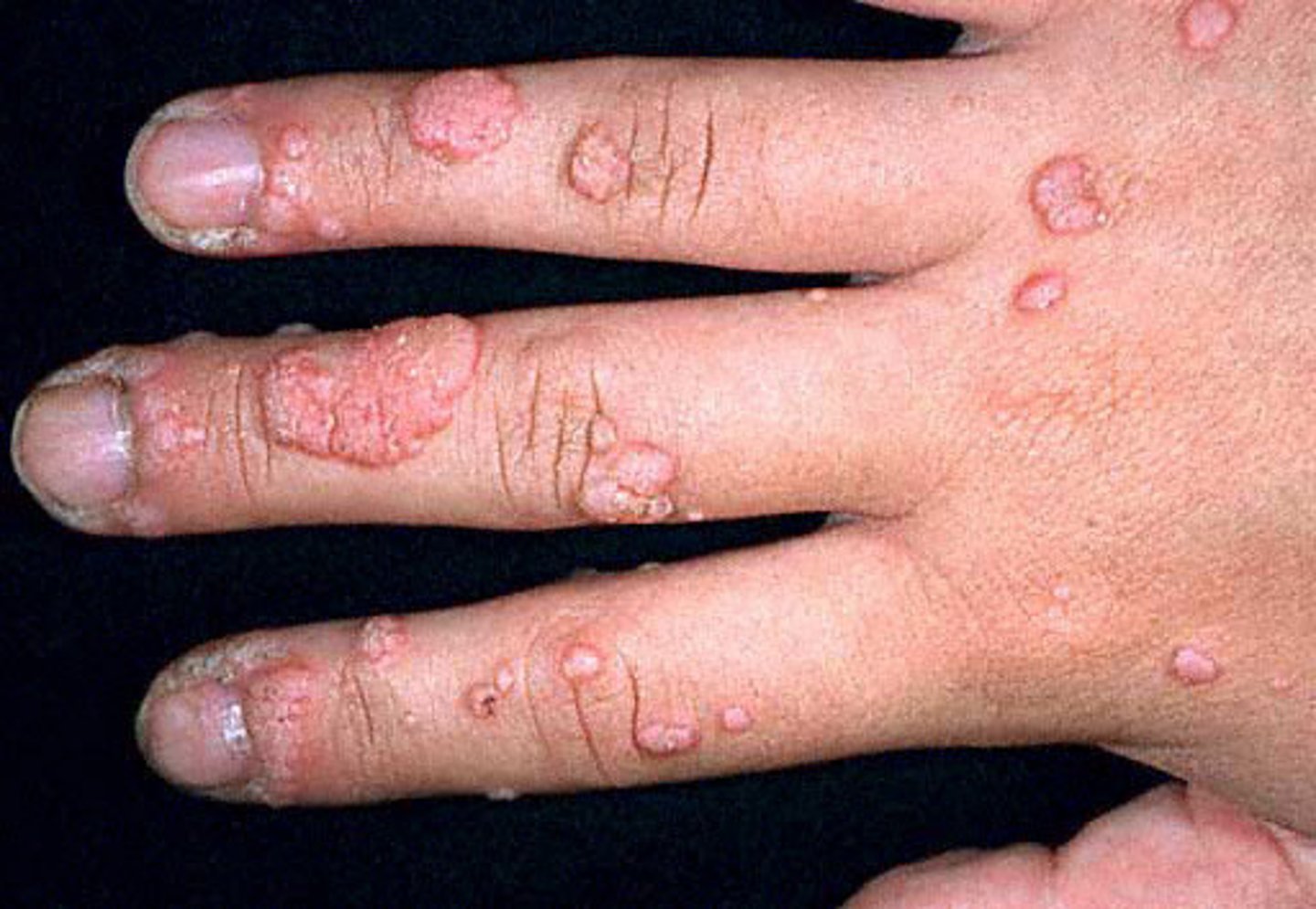 <p>wart</p>