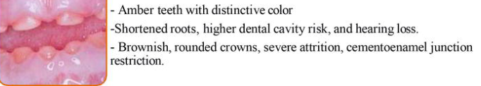 <p>no bone involvement</p><p>not associated with a syndrome</p><p>most common type of dentinogenesis imperfecta</p><p>occurs in people without another inherited disorder</p><p>caused by mutations in the DSPP (dentin sialophosphoprotein) gene</p>