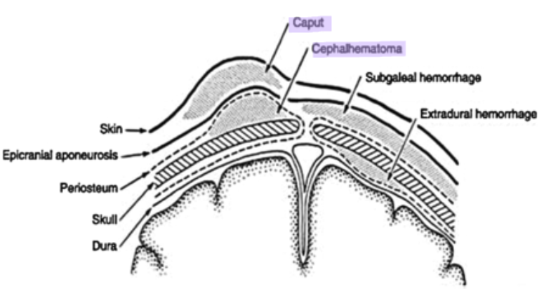 <ul><li><p>Cephalohematoma: collection of blood <em>below</em> the periosteum and does <em>not</em> cross the periosteum </p><ul><li><p>dewveops over 24 hrs </p></li></ul></li><li><p>Caput: collection of blood <em>above</em> periosteum and <em>crosses</em> suture lines </p><ul><li><p>present at birth</p></li></ul></li></ul><p></p>
