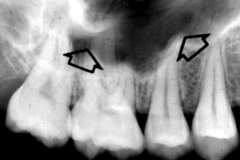 <p>maxillary sinus</p>