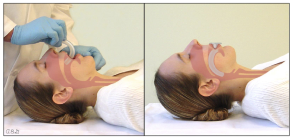 <p>Administered through the mouth and prevents the tongue from falling back and obstructing the airway </p><ul><li><p>Only administered on unconscious patients as it triggers the gag reflex</p><p></p></li></ul><p></p>