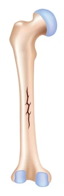 <p>Fracture line runs <strong>parallel</strong> to the long axis of the bone, caused by <strong>longitudinal force</strong> or <strong>compression</strong>, often <strong>minimally displaced</strong>.</p>