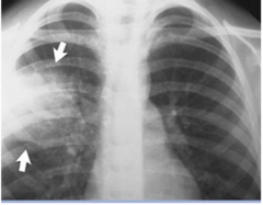 <p>made by a history and physical, chest xray, blood cultures to confirm or rule out bacteremia, sputum examination and culture. bronchoscopy may be used in severe cases.</p><p>in this photo it indicates a more opaque left side which shows fluid or mucus build up indicative of pneumonia in the area.</p><p>for planning you want to ensure hydration and nutrition, make sure the patient understands the treatments and preventative measures, monitor for complications, and try to prevent complications... do discharge planning specifically to the patients needs</p><p>some nursing diagnoses: ineffective airway clearance, impaired gas exchange, activity intolerance</p>