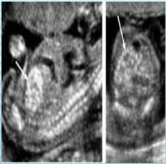 <p>Bright bowel caused by a build-up of meconium, gastrointestinal pathology, or fetal ingestion of blood. The diagnosis is made if the bowel is as echogenic or more echogenic than bone.</p>