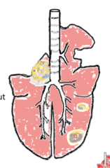 <p>1. Occurs following bronchopneumonia of following spread form other conditions</p><p>2. Mastitis, metritis, navel-ill, caudal vena cava thrombosis. May be multiple of single abscesses</p>