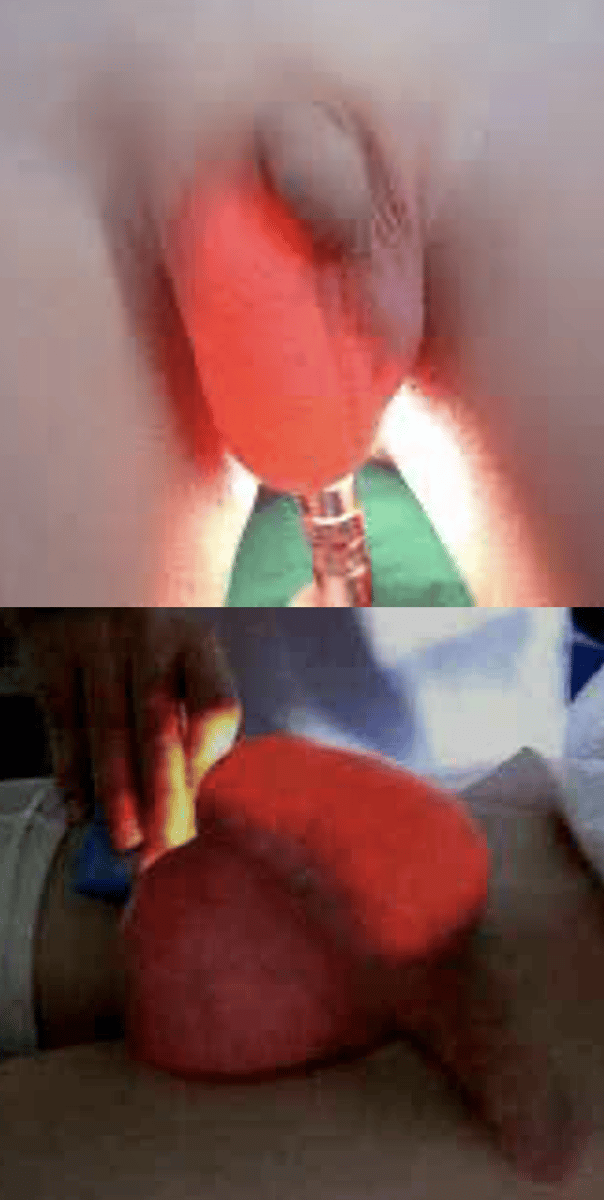<p>Unilateral scrotal enlargement with transillumination</p>