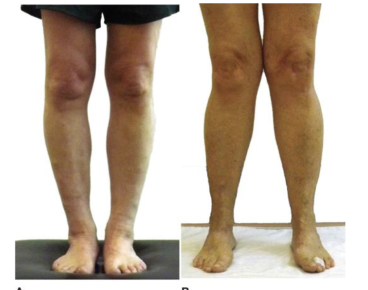 <p>Tibiofemoral angulation </p>