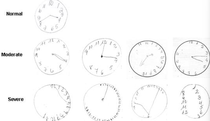 <p>Used when you need to screen for cognitive impairment in otherwise healthy older adults</p><p>Consists of 3-item recall test</p><p>Clock Drawing test</p><p>Total Score 0-5</p><p>Score 3, 4, or 5 → Lower likelihood of Dementia</p><p>Score < 3 → Validated for dementia screening and further assessment</p>