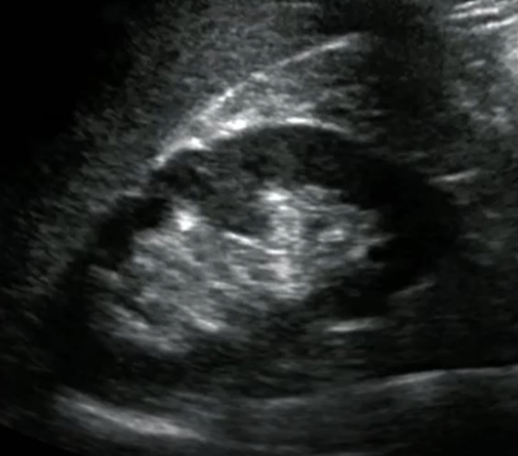 <p>Prominent folds of renal cortical tissue that protrude down into the medulla towards the renal sinus</p><ul><li><p>Clearly separated from the renal sinus</p></li><li><p>Continguous with renal cortex</p></li><li><p>Echogenicity is the same as the cortex/renal parenchyma</p></li><li><p>Not over 3 cm in size as a rule</p></li></ul><p></p>