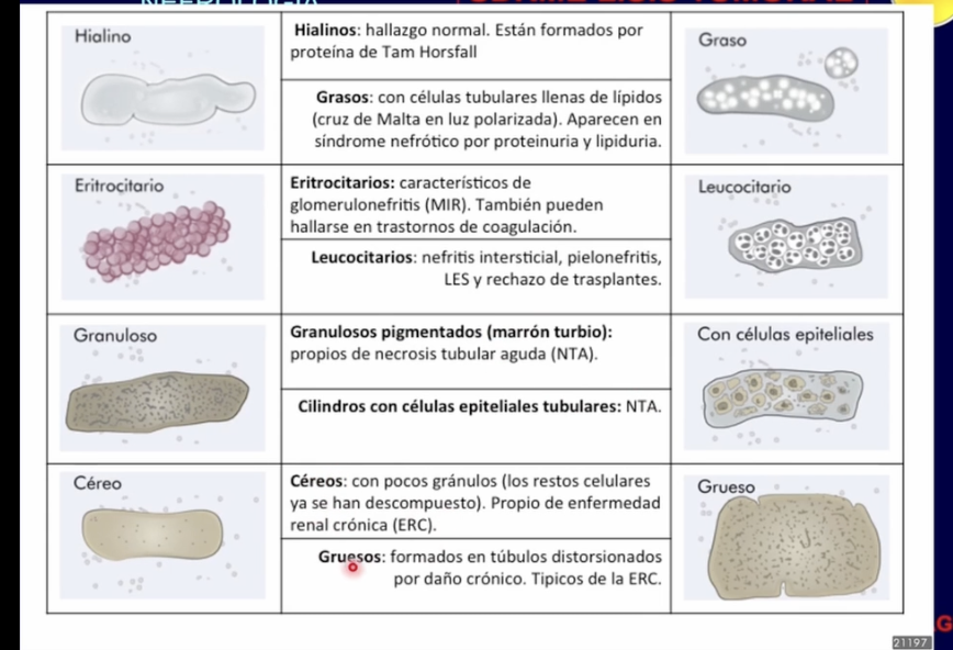 <p>Cilindros relacionados con sd nefrótico y nefrítico</p>