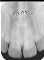 <p>Superior Foramina of Incisive Canal</p>