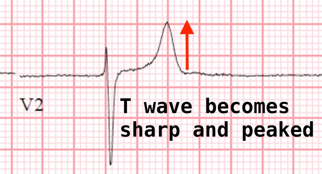 <p>Tall peaked T waves</p>