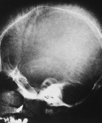 <p>What is the most likely diagnosis?</p>