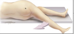 <p>Pain on passive extension (or flexion) of the right thigh. Patient lies on left side.</p><p>Examiner extends patient's right thigh while applying counter resistance to the right hip (asterisk)</p>