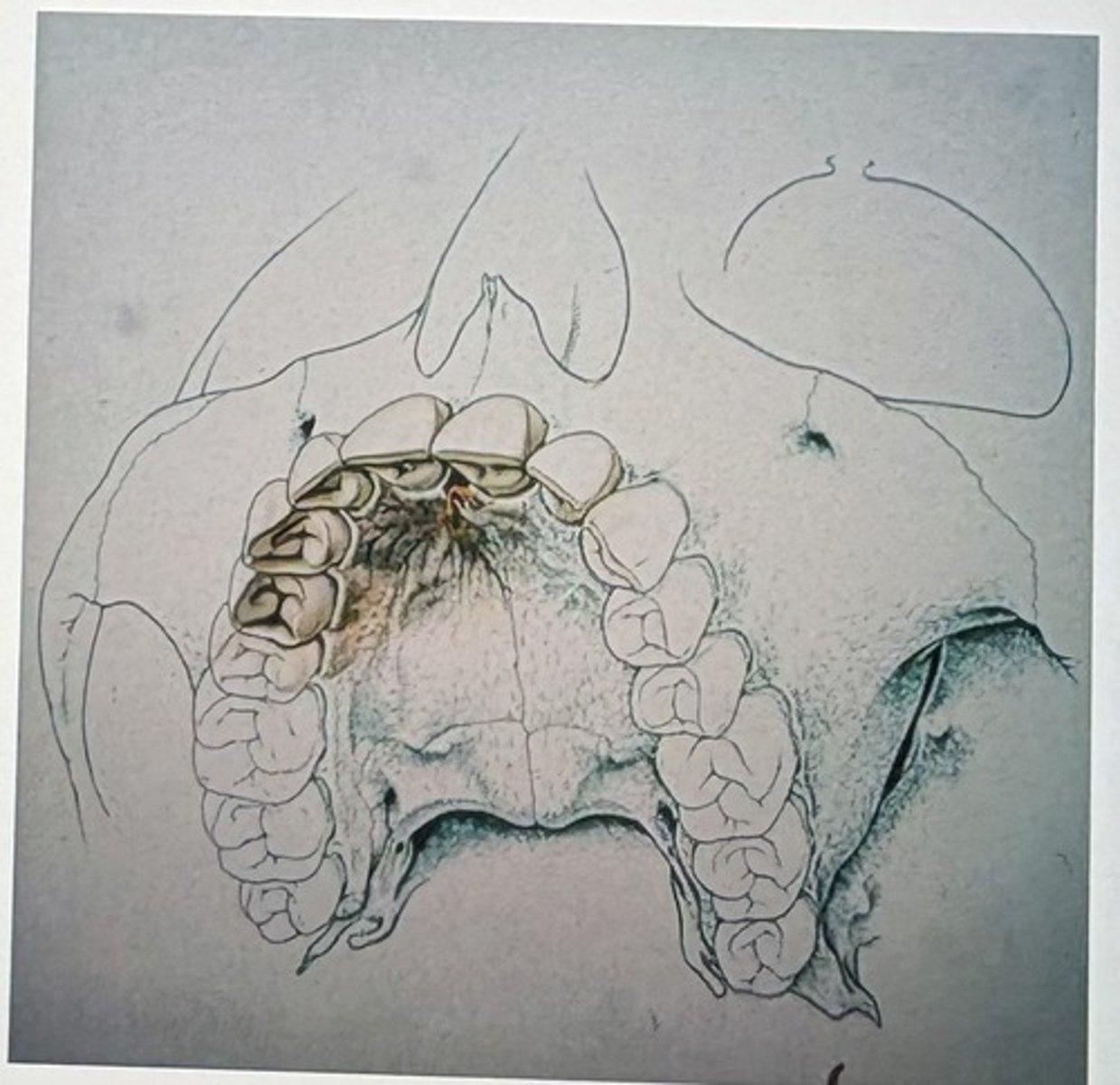 <p>What landmarks are anesthetized with a nasopalatine block?</p><p>teeth & tissues and other name</p><p></p>