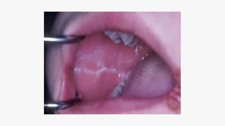<ul><li><p>Bruxism </p></li><li><p>friction </p></li><li><p>teeth out of alignment </p></li></ul><p></p>