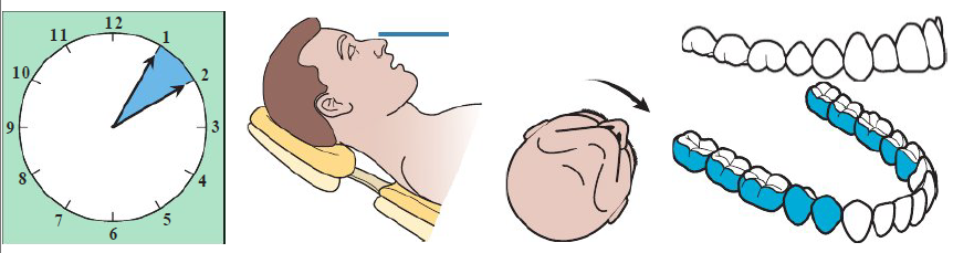 <ul><li><p>Clinician in 1 to 2 o’clock position</p></li><li><p>Chin DOWN</p></li><li><p>Mandibular occlusal parallel to floor</p></li><li><p>Patient head: Towards clinician</p></li></ul><p></p>