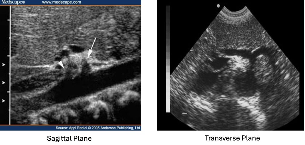 <p>What is the seagull sign on the celiac axis? </p>