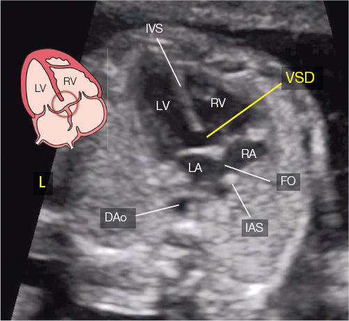 <p>Absence of part of the ventricular septum</p><p>Color Doppler is helpful at detecting small defects</p>