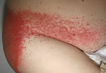 <p>Scalding red, moist patches with sharply demarcated borders, usually in genital area, caused by candida fungus and aggravated by urine, feces, head, and moisture</p>