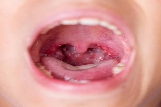<p>Infección viral común (especialmente en la infancia) caracterizada por la aparición repentina de fiebre alta y pequeñas ampollas o úlceras muy dolorosas en el fondo de la boca y la garganta</p>