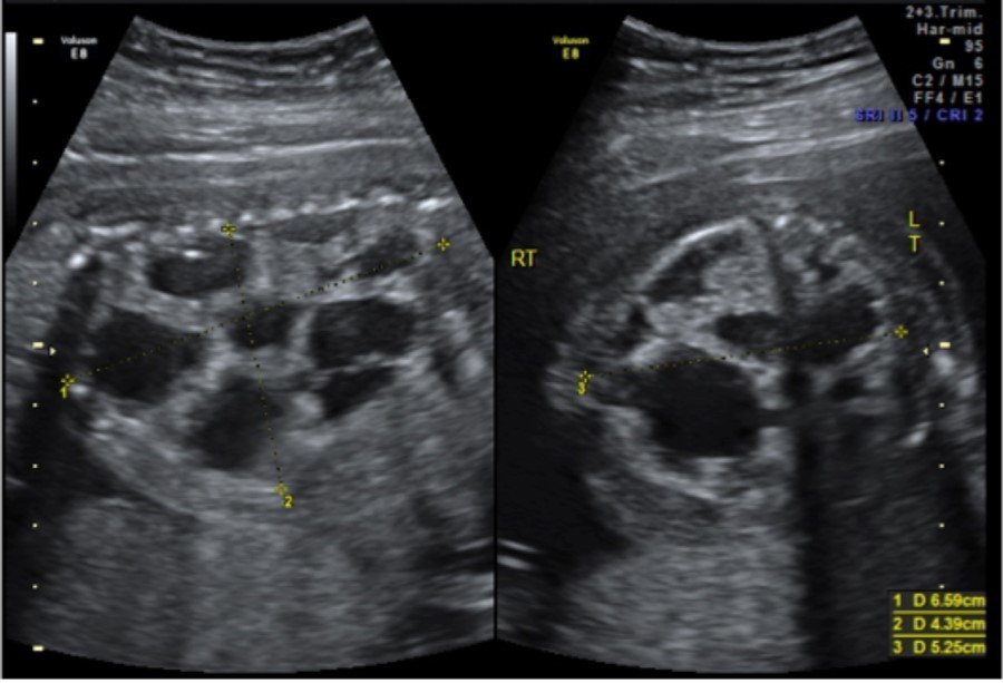 <p>Macrocystic </p><p>large visualized cyst </p>