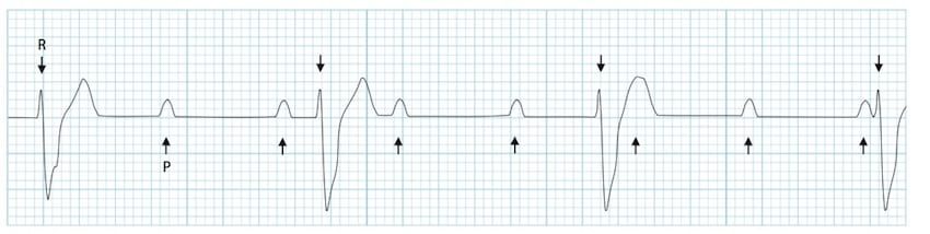 <ul><li><p>transmission of impulse from atria to ventricles fails</p></li><li><p>atria and ventricles beat independently of each other</p><ul><li><p>P and QRS complexes completely dissociated</p></li></ul></li></ul><p></p>