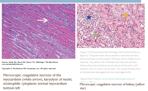 <ul><li><p>Due to ischemia, infarction</p></li></ul><p></p><ul><li><p><span style="color: red;">Increased eosinophilia</span> of the cytoplasm (denatured proteins) and <span style="color: red;">decreased basophilia</span> of the nucleus (loss of DNA/RNA).</p></li></ul><ul><li><p>General cellular architecture is initially preserved.</p></li></ul><p></p>