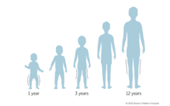 <p>Anatomic variations over the first decade</p><p>Varus -> Neutral -> Valgum</p>