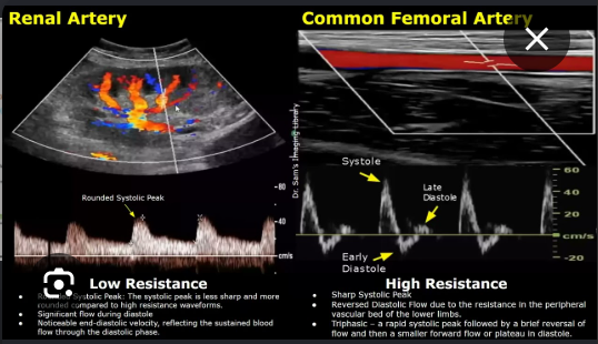 <p>What renal arteries should show similar Doppler waveform patterns?<br>→ All of the renal arteries (from main to arcuate) should show similar Doppler waveform patterns</p><p>What type of flow is normal in renal arteries?<br>→ Low resistance antegrade flow</p><p>What happens to spectral broadening deeper into the renal parenchyma?<br>→ Increases</p><p>What does absent or reduced end diastolic flow indicate?<br>→ Increased distal resistance (Indicates resistance to flow distally)</p><p>Name 3 causes of absent/reduced end diastole.<br>→ Obstructed renal artery, medical renal disease, renal vein thrombosis</p><p></p><p>Because as you sample <strong>deeper into the kidney tissue</strong>, the arteries get <strong>smaller and more branched</strong>, so the blood flow becomes a little less uniform.</p><p><strong>Spectral broadening</strong> means the Doppler waveform looks more “filled in” instead of having a clean empty window under the peak. It happens when the sample volume is picking up blood cells moving at <strong>different speeds and directions</strong>.</p><p>In the renal arteries:</p><p><strong>Main renal artery</strong> = larger vessel, more organized flow → cleaner waveform<br><strong>Segmental/interlobar/arcuate arteries inside parenchyma</strong> = smaller branching vessels → more mixed velocities → more spectral broadening</p><p>That is why your slide says <strong>increase in spectral broadening is seen as sampling is made further into the parenchyma</strong>. It can be a normal finding as you move farther into the small intrarenal vessels.</p>