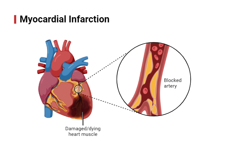 <p><span style="line-height: 107%;"><strong>BOOK:</strong></span></p><p class="MsoNormal">Death of part of the heart muscle.</p><p class="MsoNormal"><span style="line-height: 107%;"><strong>SIMPLE:</strong></span></p><p class="MsoNormal">A heart attack, when blood flow to part of the heart muscle is blocked, causing damage or death of heart tissue.</p>