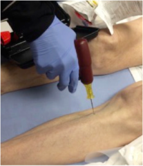 <p>Needle into bone marrow of long bone. Just as fast as IV</p>