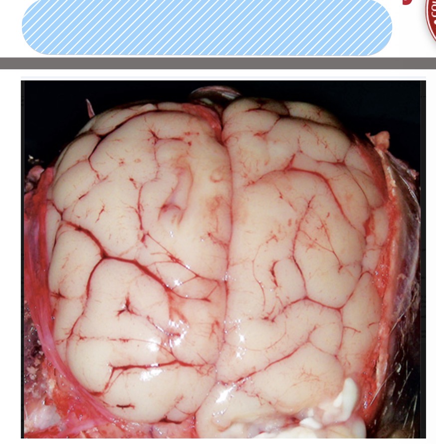 <p>Name the lesion</p>