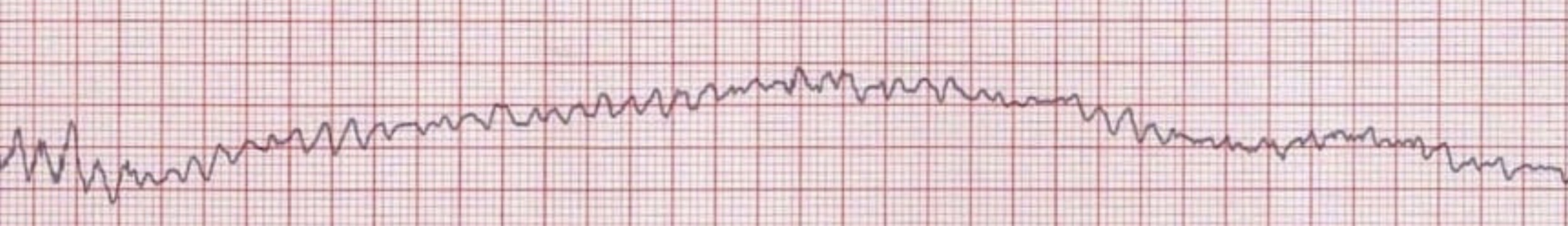 <p>What rhythm/abnormality is seen below?</p>